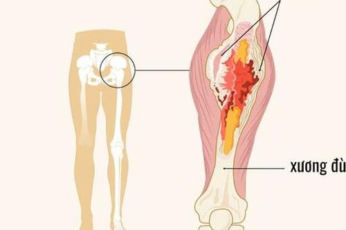 Dấu hiệu cảnh báo ung thư xương ở trẻ cha mẹ cần lưu ý