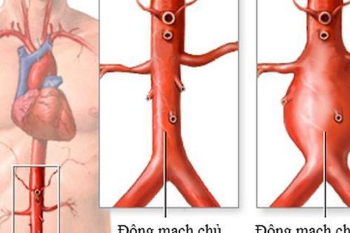 Căn bệnh khiến nghệ sĩ Bảo Anh 'Người đẹp Tây Đô' qua đời ở tuổi 68 mắc phải nguy hiểm thế nào?
