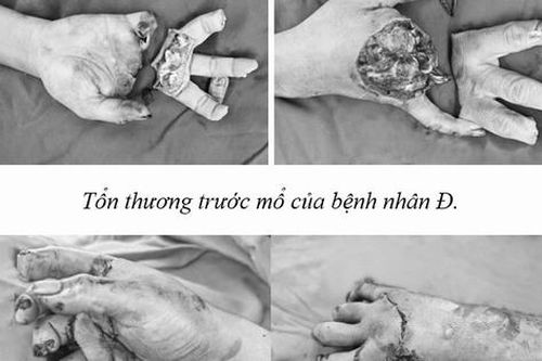 Xuyên đêm nối thành công 3 ngón tay bị đứt rời do tai nạn lao động
