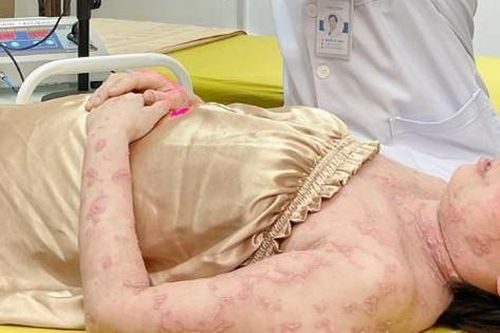 Chuyên gia khuyến cáo cách kiểm soát bệnh vảy nến