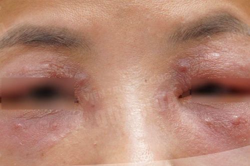 Người phụ nữ nhập viện sau tiêm meso giảm thâm mắt