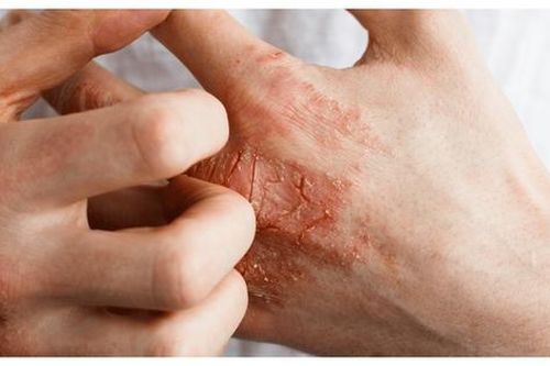 Viêm da cơ địa dùng thuốc gì để giảm ngứa?