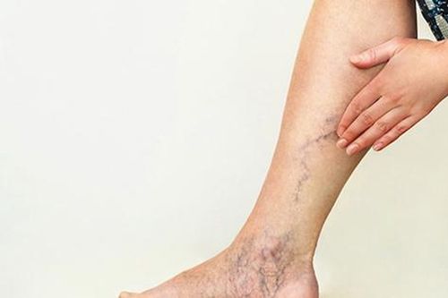 Bài thuốc Đông y trị suy giãn tĩnh mạch chân