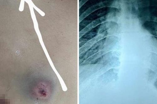 Đang làm rẫy, người đàn ông trúng 'đạn lạc' xuyên ngực