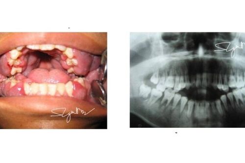 Bị viêm lợi cấp, đi khám phát hiện bệnh u máu ác tính