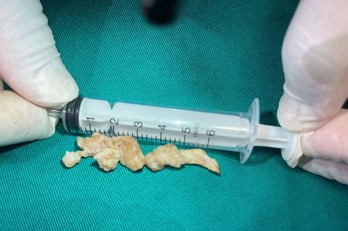 Nhập viện khi đang ăn cơm với chả lá lốt