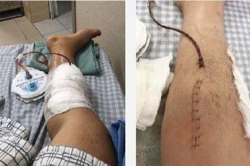 Suýt hỏng chân do tự ý kết hợp thuốc chữa đau khớp