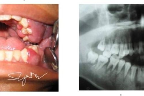 Viêm khoang miệng đi khám phát hiện ung thư máu ác tính