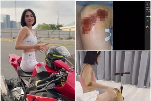 Ngọc Trinh công khai những vết xây xát khắp người sau khi ngã moto