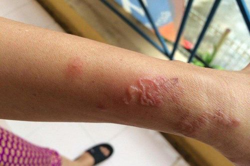 Bỗng sụt 8kg, đi khám hóa ra giun đũa 'lạc trôi' vào tận gan