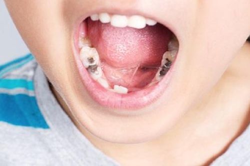 Sâu răng ở trẻ gây nhiều tác hại hơn cha mẹ nghĩ