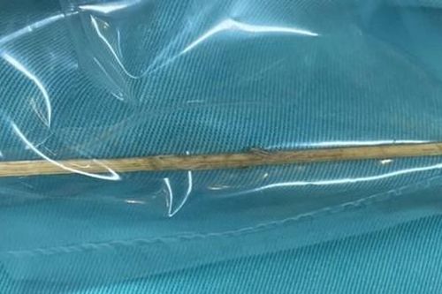 Tăm tre 10 cm đâm thủng đại tràng