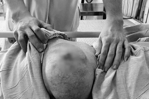 Cắt bỏ khối u 20cm nằm ở vùng mông suốt 30 năm cho cụ ông 97 tuổi