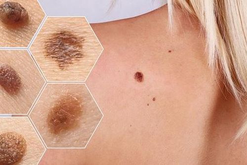 Tin vui cho những người nguy cơ bị ung thư da, sử dụng công cụ này có thể chẩn đoán chính xác bệnh 99%