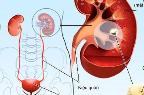 7 cách phòng bệnh sỏi thận dễ thực hiện