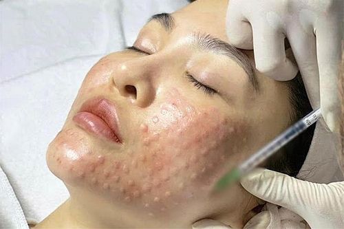 Nên tiêm Meso thông thường hay cấy Meso Extra? Giải đáp từ Bác sĩ Thanh Diễm
