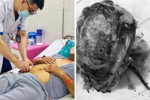 Phẫu thuật cắt bỏ khối u thận to gấp 1,5 lần quả thận cho người đàn ông 66 tuổi