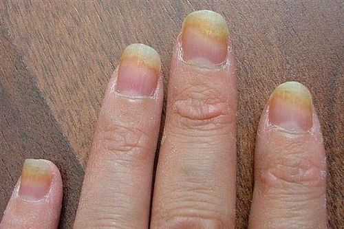 Cách điều trị nấm do sơn móng