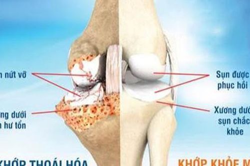 Bài thuốc làm chậm thoái hóa khớp