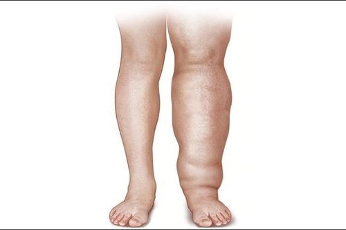 WHO tuyên bố Lào đã xóa bỏ bệnh bệnh phù chân voi