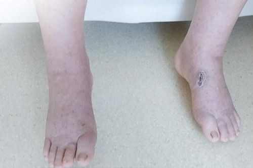 Bị phù chân, khó thở vì sử dụng thực phẩm chức năng 'nhập ngoại' có chứa Corticoid