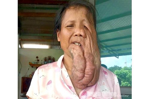 Nỗi khổ của người mẹ đơn thân mang trên mặt khối u hơn 1kg