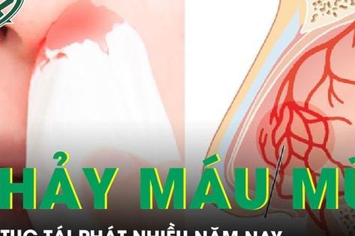 Chảy máu mũi tái phát nhiều năm do các dị dạng mạch hốc mũi