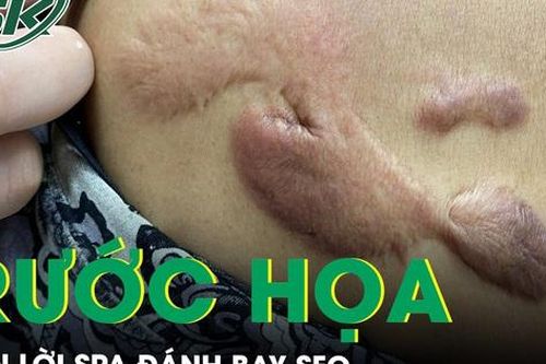 Tiền mất tật mang vì 'cú lừa' của spa đánh bay sẹo lồi
