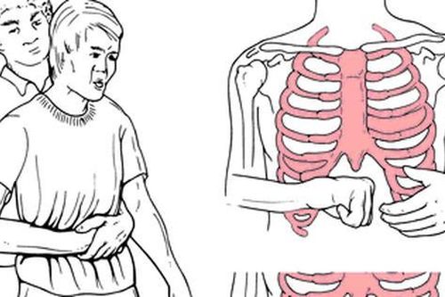 Xử trí nghẹn thức ăn, hóc dị vật bằng nghiệm pháp Heimlich cần biết những điều này