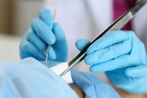 Bác sĩ trả lời: Cắt u mỡ có bị mọc lại không?
