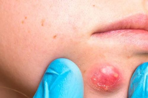 Nguy cơ nhiễm trùng nếu điều trị mụn nhọt không đúng cách