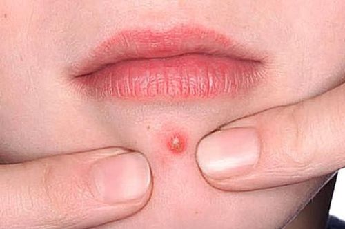 Cách điều trị mụn nhọt hiệu quả
