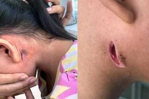 Một bệnh nhân tử vong vì nhiễm 'vi khuẩn ăn thịt'