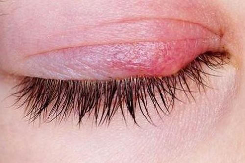 Món ăn bài thuốc hỗ trợ chữa viêm bờ mi