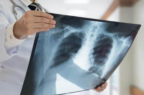 Trí tuệ nhân tạo giúp sàng lọc ung thư phổi sớm