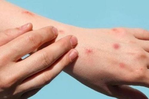 18/20 ca đậu mùa khỉ ở TPHCM nhiễm HIV