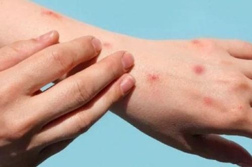 TP HCM: Ghi nhận ca tử vong đầu tiên liên quan đến bệnh đậu mùa khỉ