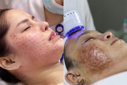 Sự khác biệt giữa Meso thông thường và Meso Extra kết hợp với máy Bellasonic 2x