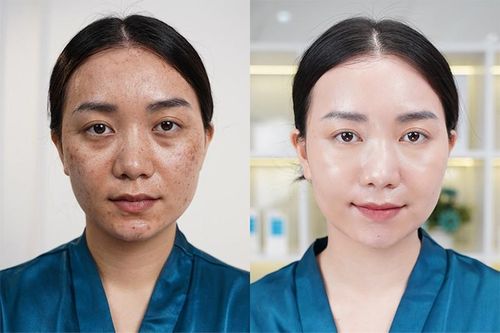 Cách lựa chọn địa chỉ cấy Meso Extra uy tín, an toàn