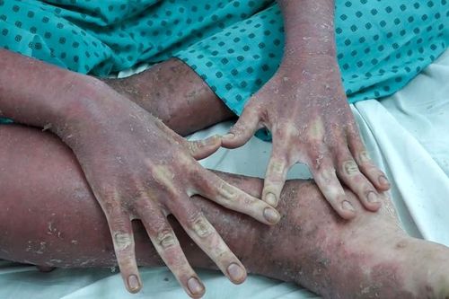 Cảnh báo việc bệnh nhân mua thuốc vảy nến qua mạng để sử dụng