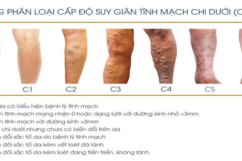 Bác sĩ trả lời: 26 tuổi bị phù chân, đau nhức có bất thường?