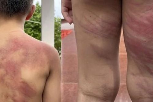 Bé trai 5 tuổi bị cha ruột đánh tàn bạo
