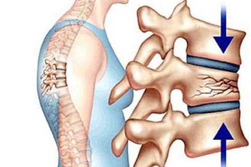 Nữ bệnh nhân bị gãy đốt sống vì chủ quan với bệnh xương khớp, đây là dấu hiệu ngầm cảnh báo bệnh!