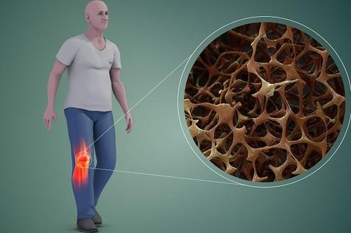 Căn bệnh nếu diễn biến nặng sẽ khiến xương giòn và xốp, chỉ ho cũng có thể gãy