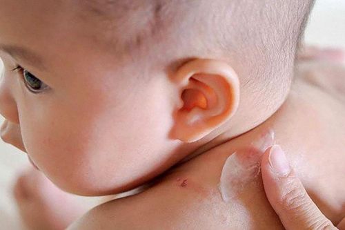 Viêm da cơ địa ở trẻ em dễ tái phát, biện pháp chăm sóc da đúng cách