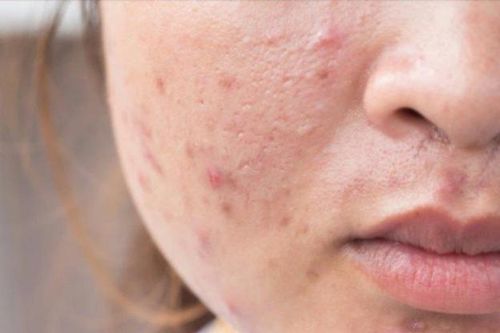 Gel bôi ngoài da trị mụn trứng cá