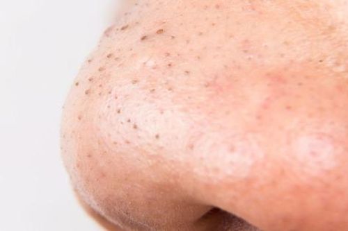 Làm sạch mụn đầu đen với 4 nguyên liệu thiên nhiên sẵn có
