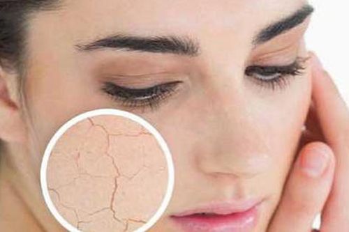 Nguyên nhân da khô, cách khắc phục và phòng ngừa da khô bong tróc