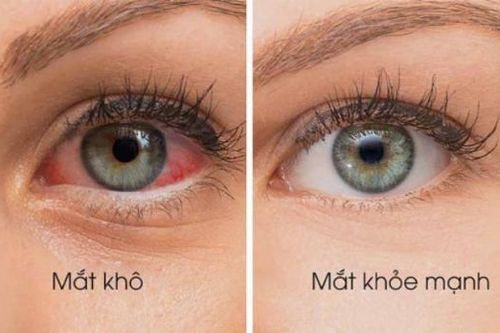 5 bài thuốc giúp giảm các triệu chứng khô mắt