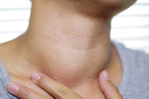 Bướu cổ nguy hiểm như thế nào?